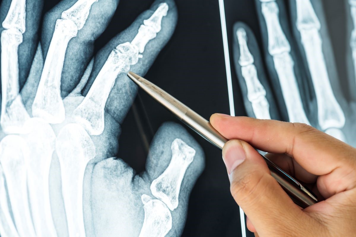 closeup x ray film fractured finger