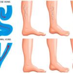 34482352 2205.i504.015.P.m005.c25.realistic varicose veins anatomy set
