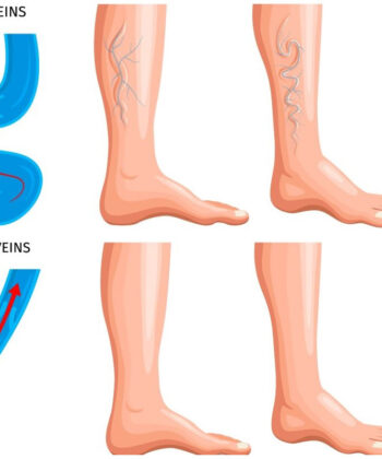 34482352 2205.i504.015.P.m005.c25.realistic varicose veins anatomy set
