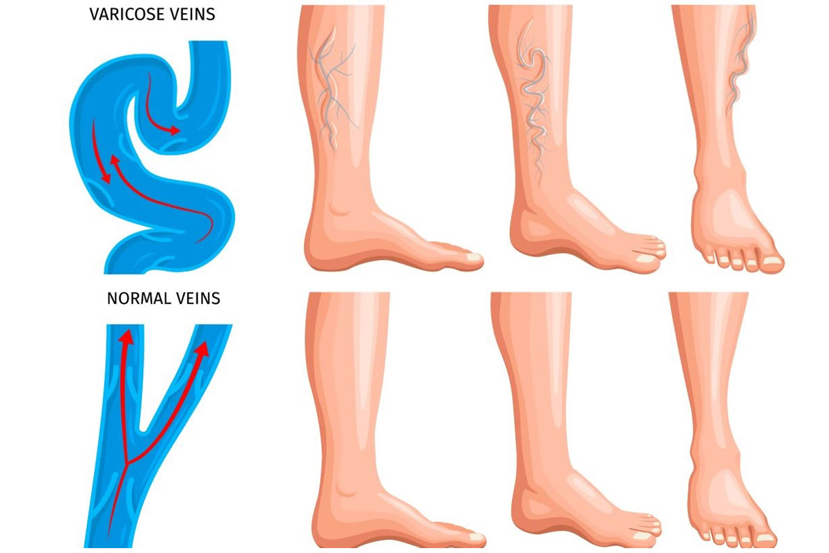 34482352 2205.i504.015.P.m005.c25.realistic varicose veins anatomy set 34482352 2205.i504.015.P.m005.c25.realistic varicose veins anatomy set